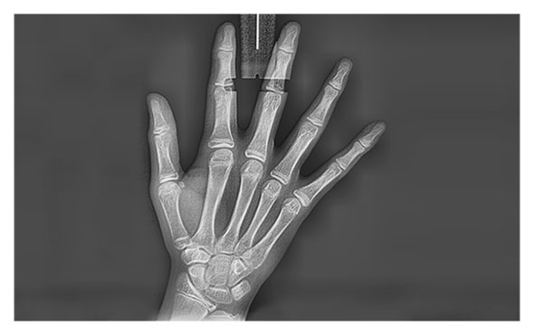 Radiografa Carpal
