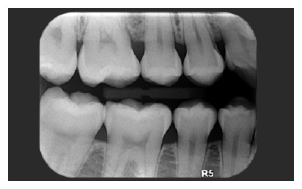 Radiografias coronales