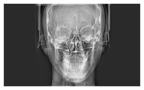 Radiografa Posteroanterior